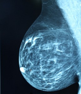 RT in breast cancer