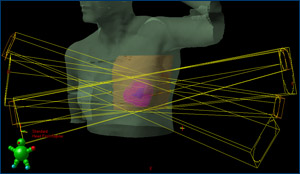 Accelerated Partial Breast Irradiation (APBI) Trial For Breast Cancer Shows Promise