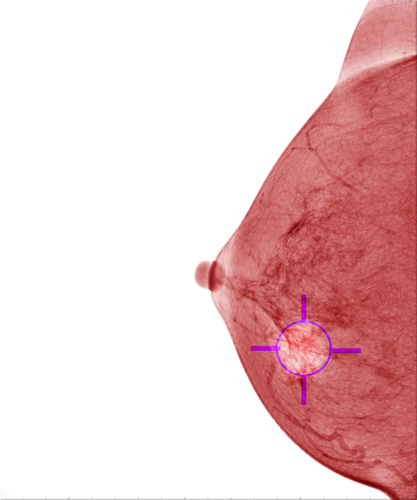 UC Irvine to Study Philips’ New Breast Density Screening Technology
