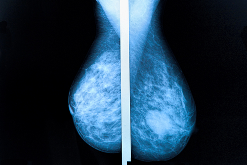 dense breast tissue