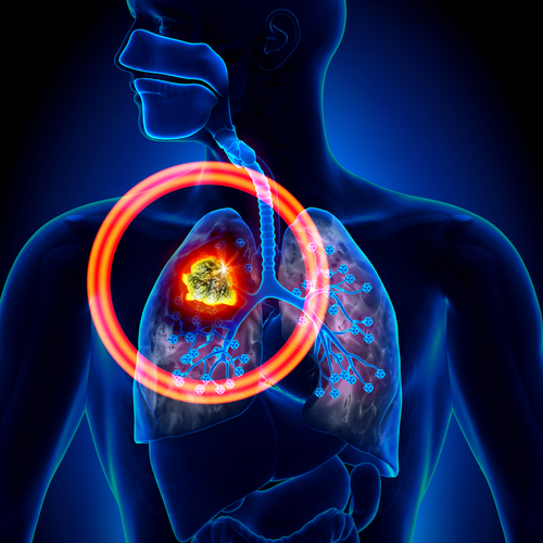 Oligometastatic Lung Tumors Effectively Treated Using Particle Beam Radiation Therapy