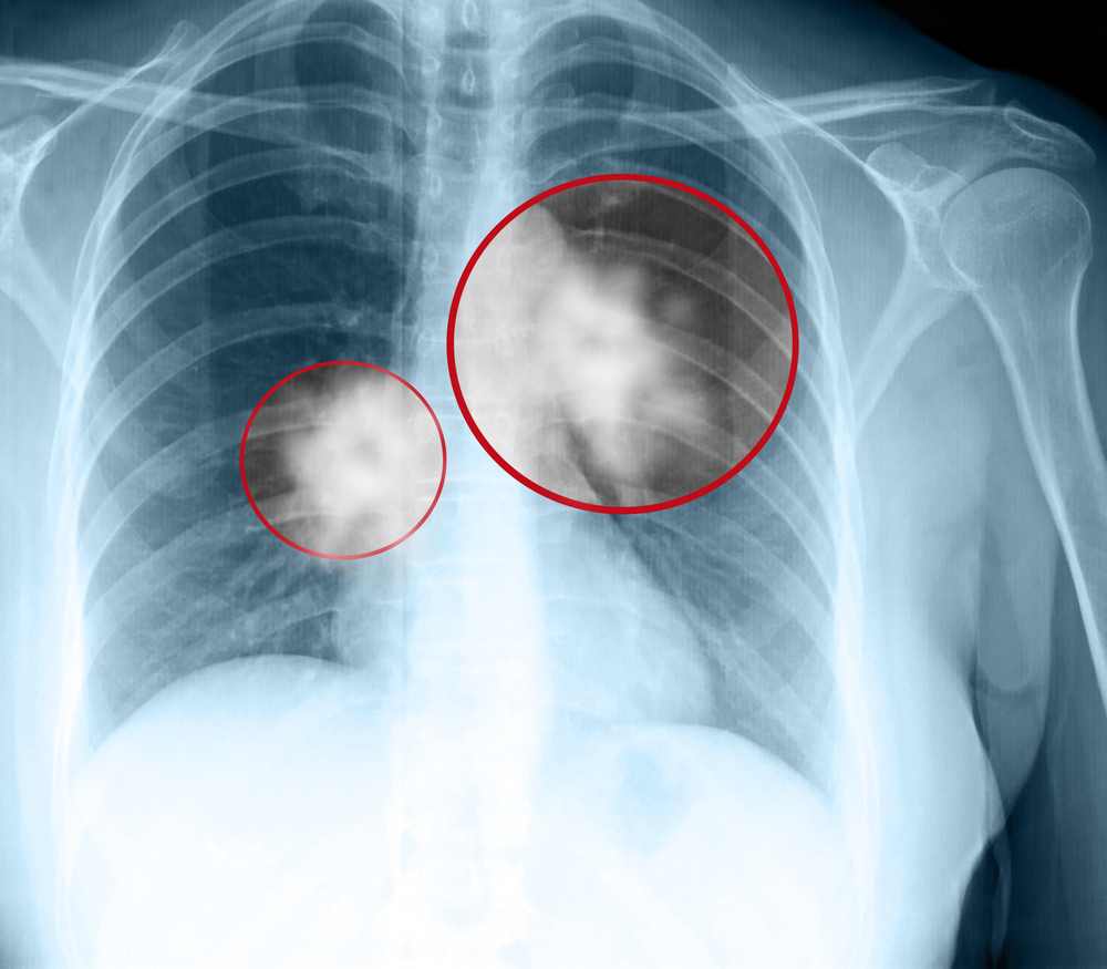 Study Analyzes Osteopontin For Prognostic Information In Radiotherapy of NSCLC