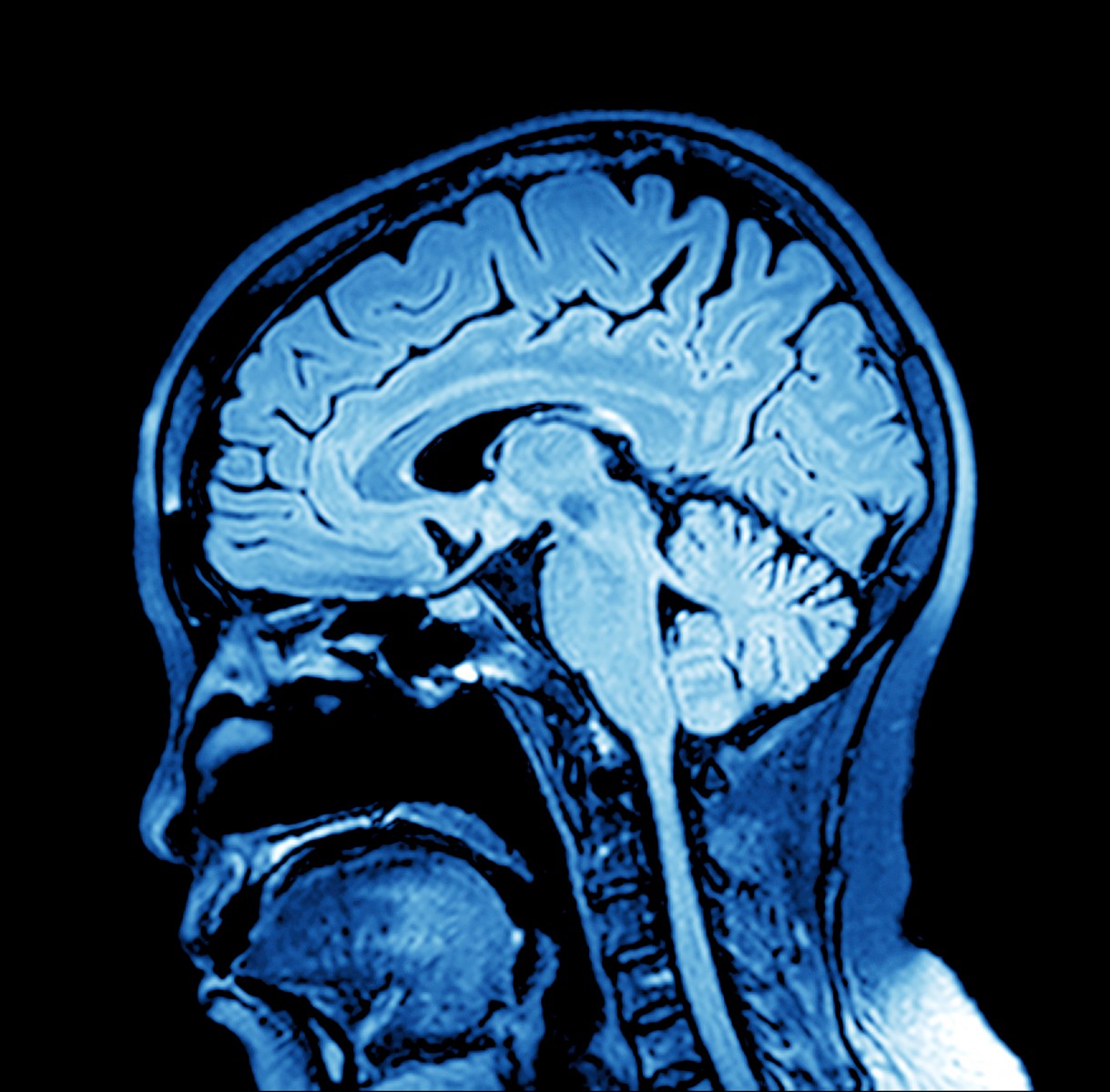 Whole Brain Radiation Therapy Poses Threat to Cognitive Function